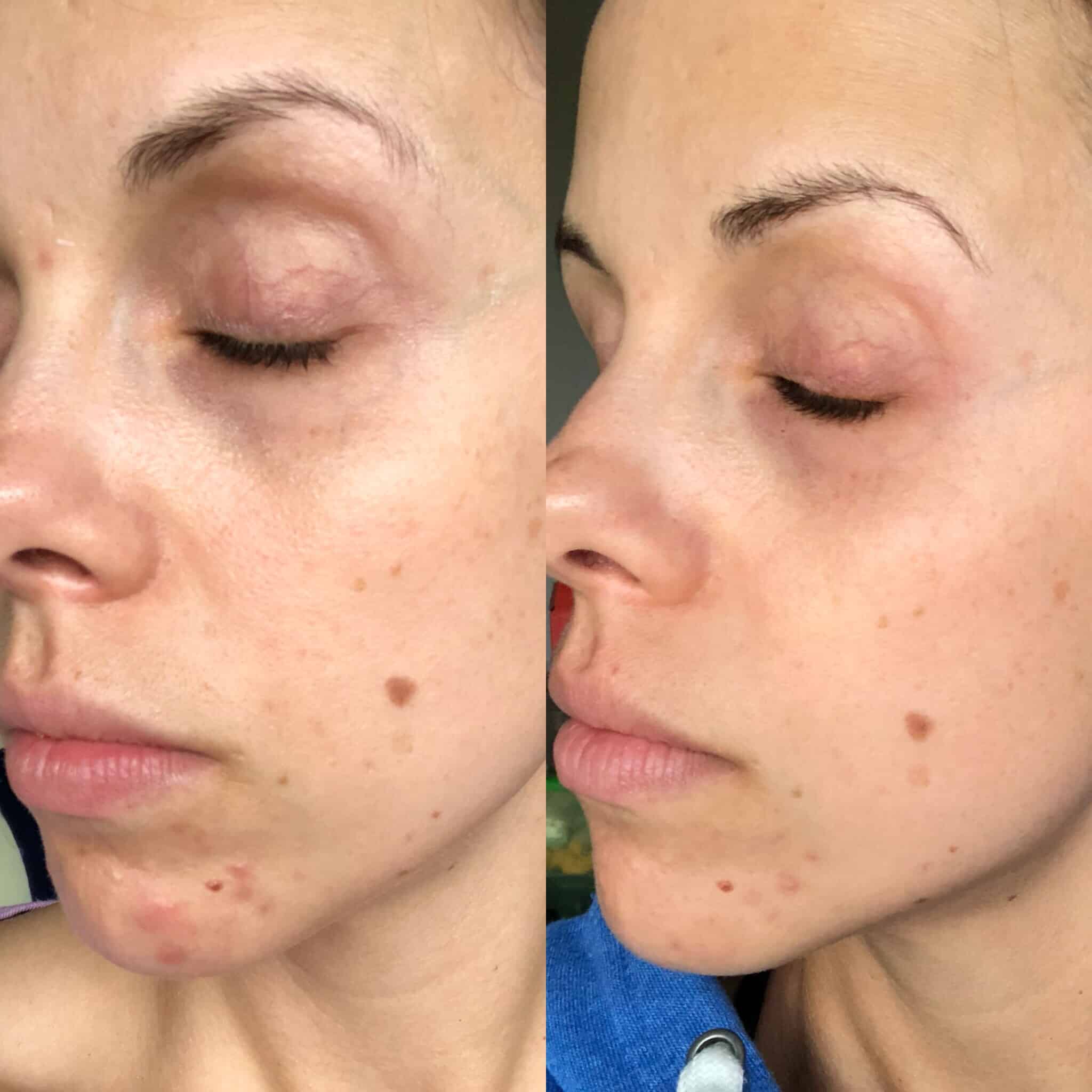 link between gut health and hormonal acne and how to treat hormonal acne