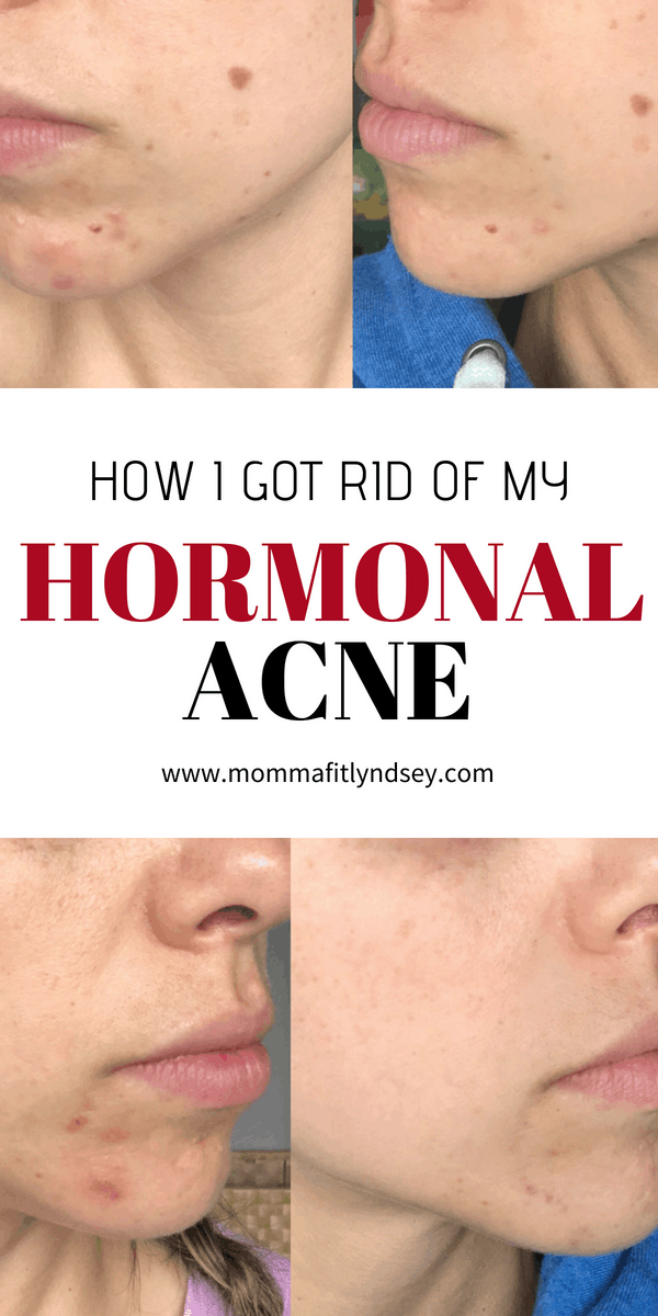 how to get rid of hormonal acne