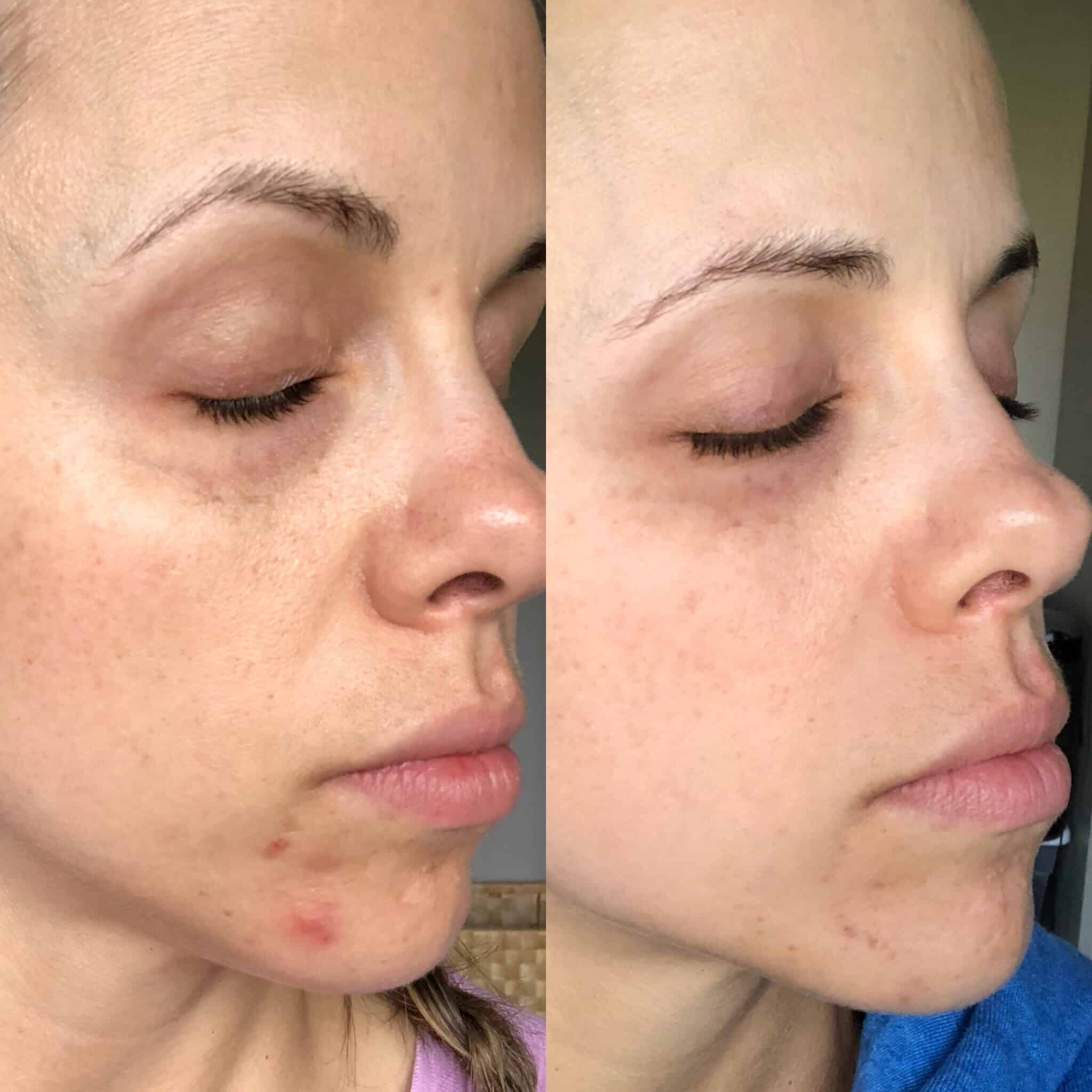 how to get rid of leaky gut and soothe hormonal acne